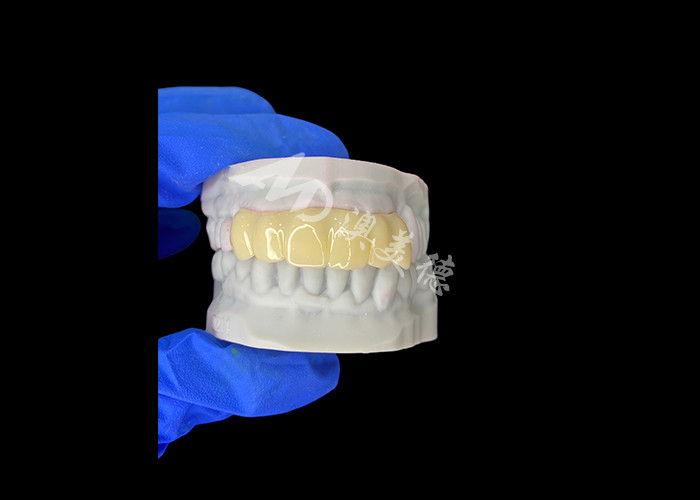 Ponte temporária oculta e leve, compatível com a biologia, impressa em 3D, para restaurações pré-implantes
