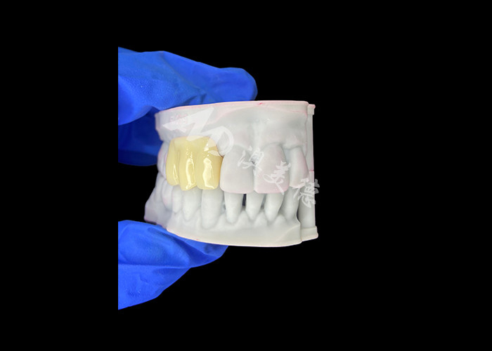 Ponte temporária oculta e leve, compatível com a biologia, impressa em 3D, para restaurações pré-implantes