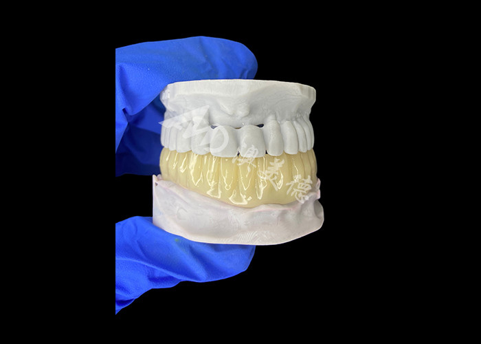 Ponte temporária oculta e leve, compatível com a biologia, impressa em 3D, para restaurações pré-implantes