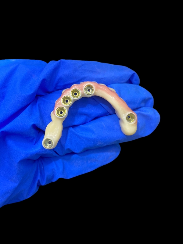 Abutment de titânio e implante de coroa de zircônio dentaduras apoiadas precisão adequado para uso confortável