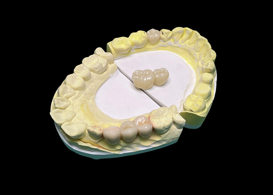 Bom preço Coroas e pontes de cerâmica de translucidez avançada melhoram seu sorriso com precisão e estética natural para durabilidade duradoura on-line