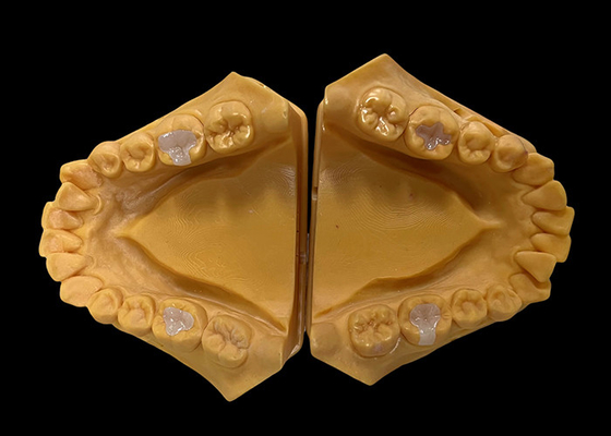 Bom preço Inlays de cerâmica biocompativeis Inlays de restauração dental sem costura com resistência à mancha on-line