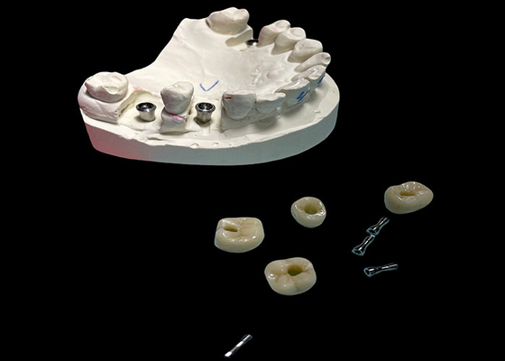 Bom preço Parafusos para implantes dentários de superfície polida coroa retida para substituição dentária on-line