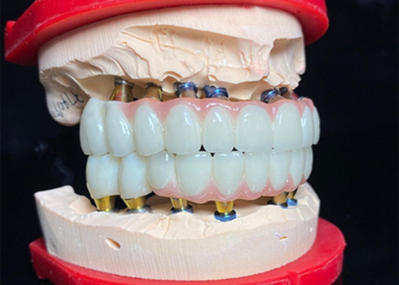 Bom preço Implante dental de base de titânio polido ponte de coroa cerâmica para restauração dental on-line