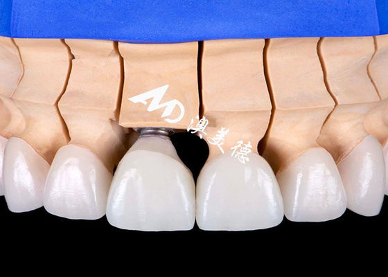 Bom preço Ponte de coroa de implante dentário com base de liga de titânio biocompatível com estética de aparência natural on-line