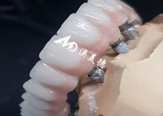 Bom preço Exclusivo Implante Dental de Alto Desempenho Crown Bridge Vários Tamanhos Disponíveis on-line