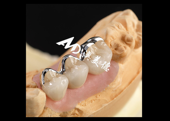 Bom preço Porcelana PFM forte fundida com coroa de metal Excelente biocompatibilidade Resistência ao desgaste on-line