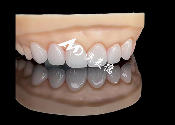 Bom preço Porcelana EMAX Veneer Restaurações estéticas de alta precisão com durabilidade superior on-line
