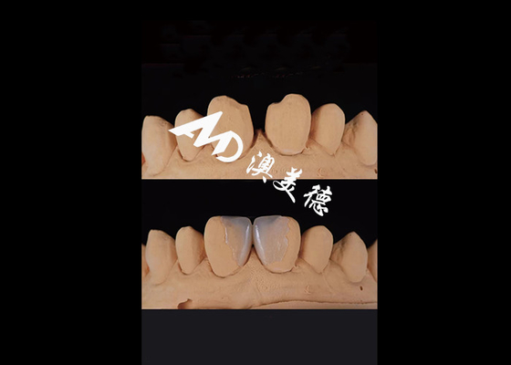 Bom preço 0.3-0.5mm Ultra fina IPS EMAX Veneers de porcelana para Estética Smile Makeovers on-line