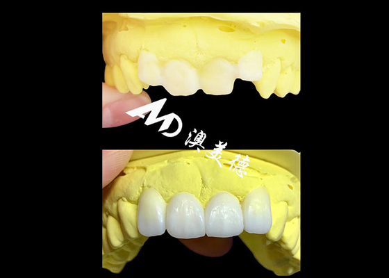Bom preço Coroas dentárias de zircônio translúcidas personalizadas fabricadas pela AMD Dental Lab on-line