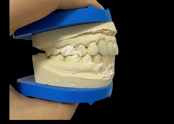 Bom preço Força imbatível Circônio Dental Coroa Dentária Para Sorrisos Naturais on-line
