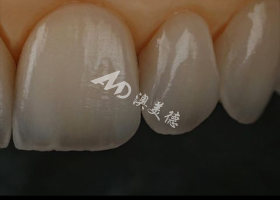 Bom preço Resistência à ruptura Coroa dental de zircônio para dentes anteriores / dentes posteriores on-line