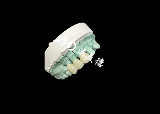 Bom preço Coroa de cerâmica Emax Solução personalizável e acessível para restauração dentária on-line