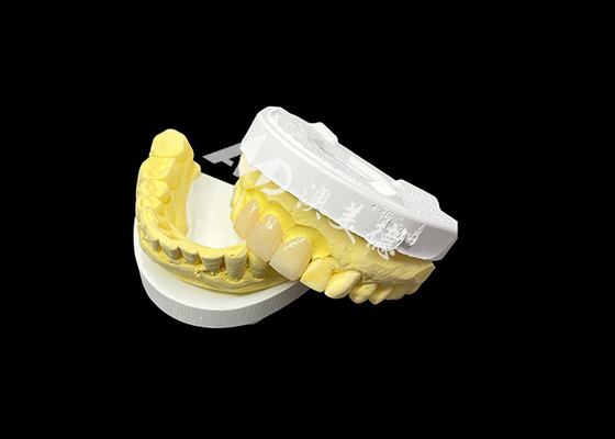 Bom preço Melhore sua estética dentária com uma ponte de coroa de cerâmica que combina estética excepcional e biocompatibilidade excepcional para um sorriso natural e confortável on-line