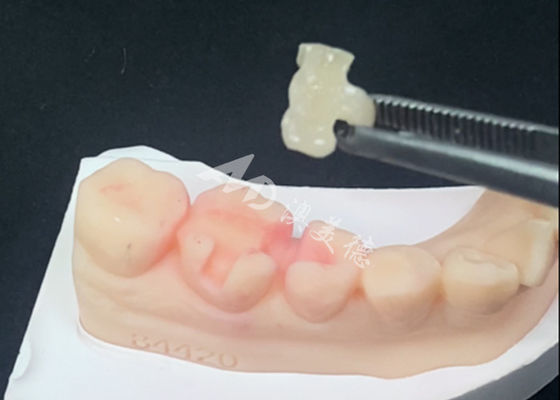 Bom preço Emax Inlays Cerâmicos Onlays Restaurações Dentárias Para a Cor Natural dos Dentes on-line