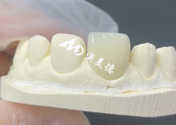 Bom preço Finete EMAX Durável e Estético A Solução Perfeita para Restaurações de Porcelana on-line