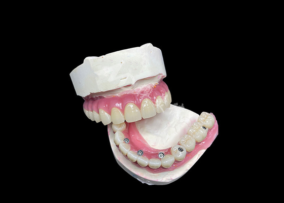 Bom preço Implante dentário de zircônio, ponte da coroa, todos no 6o andar, para substituição de dentes perdidos. on-line