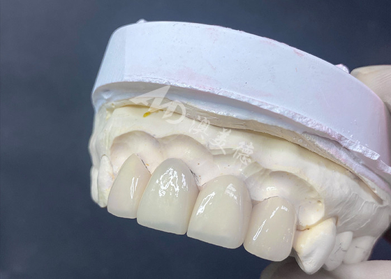 Bom preço Finetes dentários de alta precisão, de excelente ajuste e alta translucidez, para um sorriso perfeito on-line