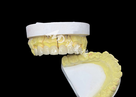 Bom preço Obtenha um sorriso perfeito com coroas dentárias de cerâmica de alta qualidade para aparência natural e resistência duradoura on-line