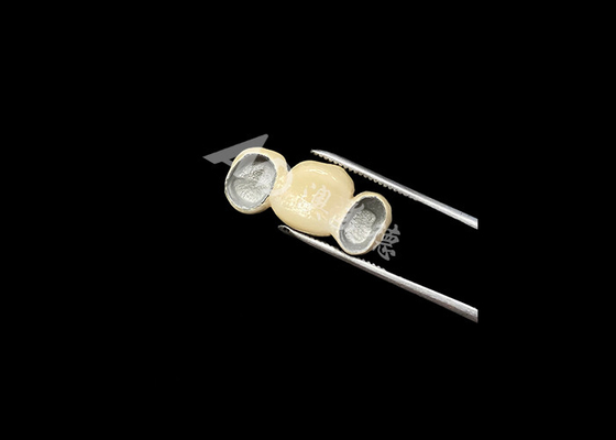 Bom preço Porcelana de ajuste preciso fundida com coroa de metal com excelente biocompatibilidade on-line