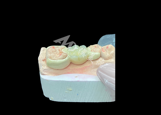 Bom preço Coroa de zircônio com ponte ligada HPP para melhorar a estética do sorriso e a biocompatibilidade on-line
