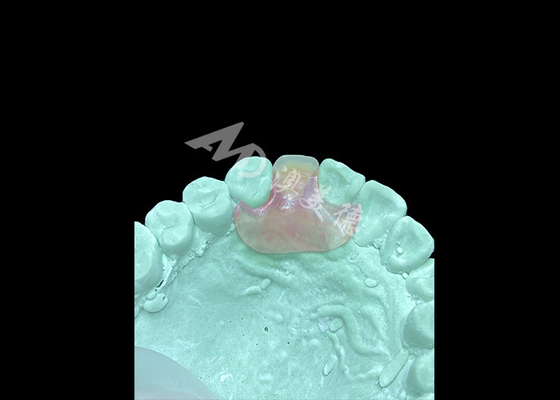 Bom preço Dentadura flexível Nesbit leve e confortável para substituição de um único dente on-line