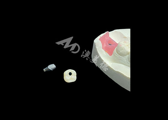 Bom preço As coroas de implantes dentários revolucionam o procedimento de odontologia restaurativa on-line