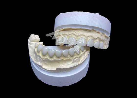 Bom preço Personalização de Facetas de Cerâmica de Vidro Ultra Finas com Alta Translucidez on-line
