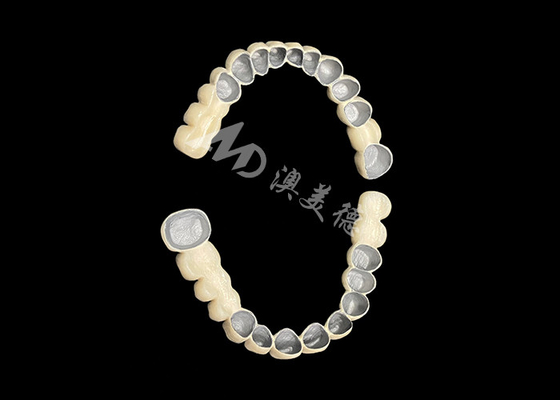 Bom preço Porcelana personalizada fundida a ponte de coroa dental de metal para melhorar o sorriso natural on-line