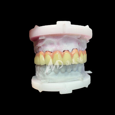 Bom preço Coroa e Ponte de Cerâmica de Titânio Puro Restaurações Duráveis, Leves e Estéticas on-line