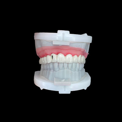Bom preço Ponte de implante de arco completo com estrutura de metal CoCr de alta resistência e camada de porcelana premium para ajuste preciso on-line